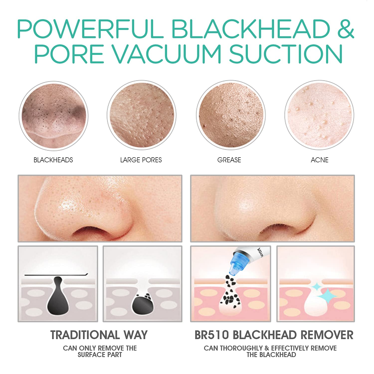 Blackhead Remover Pore Vacuum - Electric Face Vacuum Pore Cleaner Acne White Heads Removal with Suction Heads (BR510)